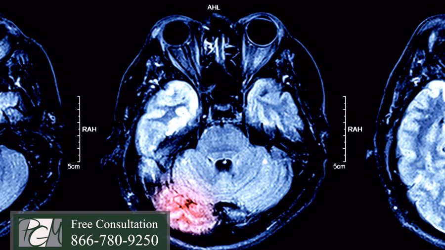 Diffuse Axonal Injury Lawyers: Brain Injury Lawyers